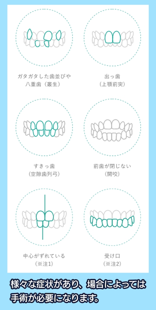 一般的な歯並びの名前