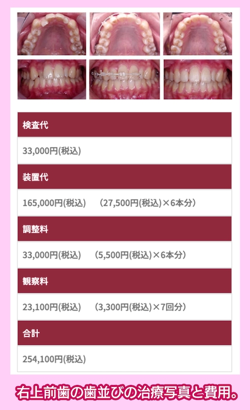 目白歯科矯正歯科の症例